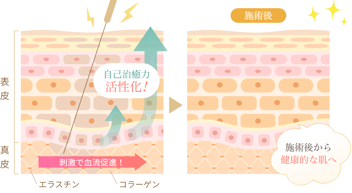 皮膚の真皮・ツボを刺激することで自己治癒力活性化させる様子を表した皮膚断面イラスト